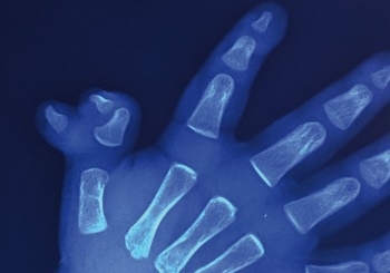 Μικροχειρουργική: Η εξειδικευμένη μέθοδος αντιμετώπισης των κακώσεων και παθήσεων του χεριού και άνω άκρου