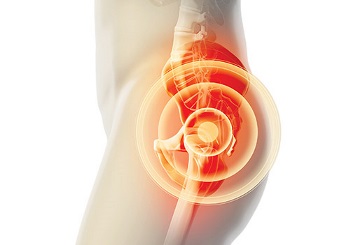 Ολική αρθροπλαστική του ισχίου με τη μέθοδο ΑΜΙS