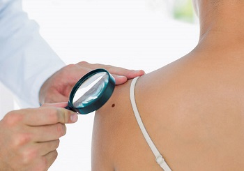 Κακόηθες μελάνωμα: Διάγνωση και αντιμετώπιση