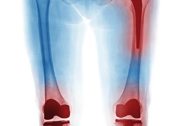 Όλες οι εξελίξεις στις ολικές αρθροπλαστικές γόνατος & ισχίου