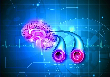 Επαναστατική θεραπεία για νευρολογικές ασθένειες με το μηχάνημα υπερήχων Exablate Neuro