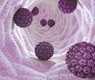 HPV Λοίμωξη - Κονδυλώματα και σύγχρονη αντιμετώπιση