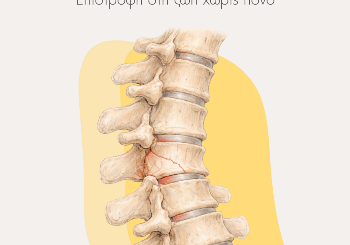 Διαδερμική Κυφοπλαστική: Λύση Χωρίς Ανοικτό Χειρουργείο για Κάταγμα Σπονδύλου