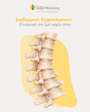 Συμβολική απεικόνιση σπονδυλικού κατάγματος