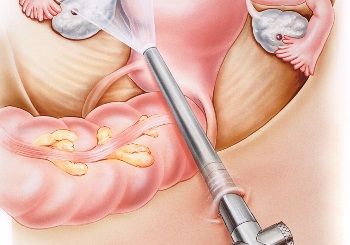 Λαπαροσκόπηση στη Γυναικολογία και τη Γυναικολογική Ογκολογία