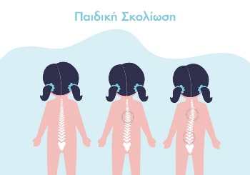 Σκολίωση στα παιδιά: Τι χρειάζεται να γνωρίζουν οι γονείς