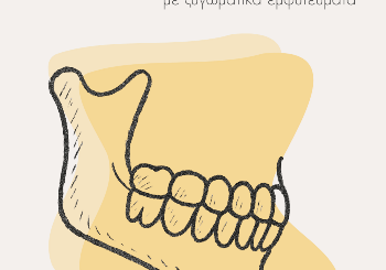 QUAD ZYGOMA: Πρωτοποριακή Αποκατάσταση Άνω Γνάθου με Ζυγωματικά Εμφυτεύματα QUAD ZYGOMA: Πρωτοποριακή Αποκατάσταση Άνω Γνάθου με Ζυγωματικά Εμφυτεύματα