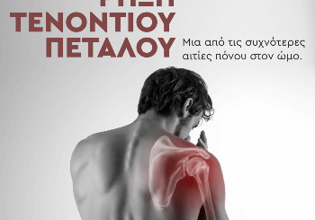Ρήξη τενοντίου πετάλου: Μια από τις συχνότερες αιτίες πόνου στον ώμο Ρήξη τενοντίου πετάλου: Μια από τις συχνότερες αιτίες πόνου στον ώμο