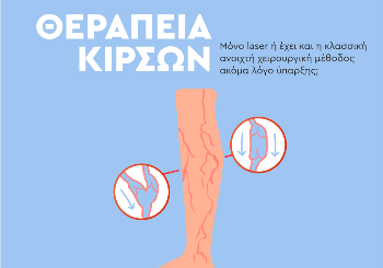 Θεραπεία των Κιρσών: Laser και κλασσική ανοικτή χειρουργική μέθοδος