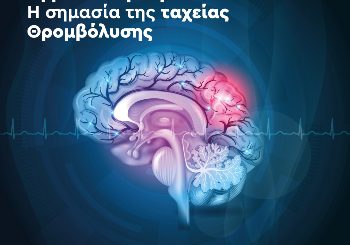 Αγγειακό Εγκεφαλικό Επεισόδιο: Η σημασία της ταχείας θρομβόλυσης